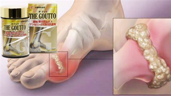 Làm sao để bệnh Gout thuyên giảm?